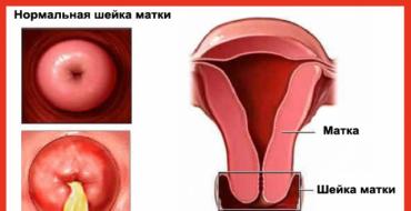 Cervicitis: causes, types, diagnosis and treatment of the disease